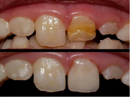 Composite Resin Restoration