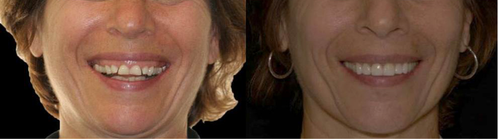 Interdisciplinary Porcelain Restoration