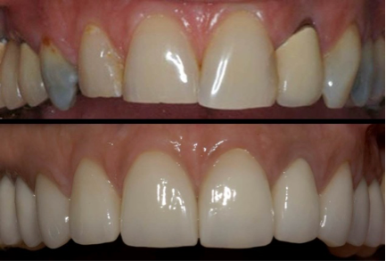 Porcelain Restoration